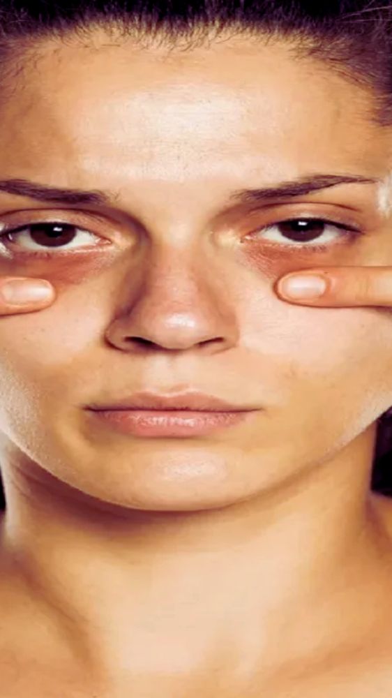 इन चीजों का करें इस्तेमाल, डार्क सर्कल्स की समस्या से मिलेगा छुटकारा इन चीजों का करें इस्तेमाल, डार्क सर्कल्स की समस्या से मिलेगा छुटकारा