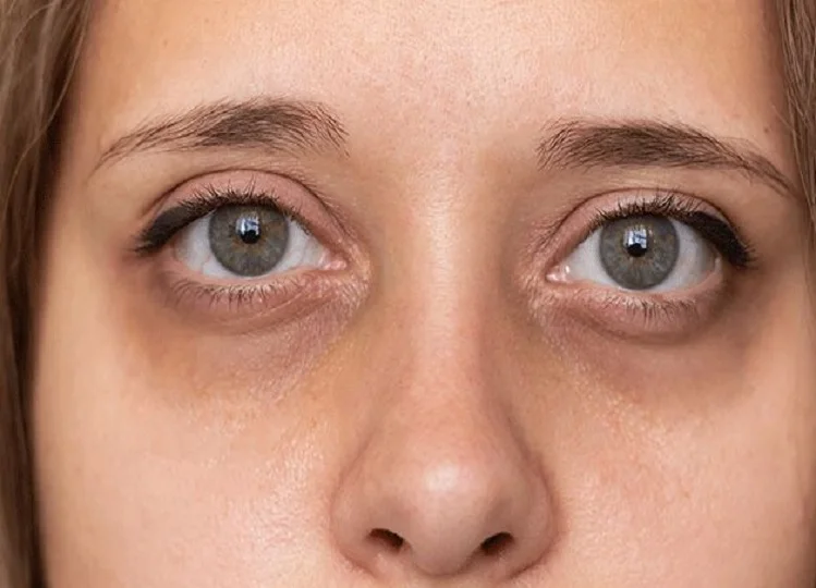 Beauty Tips: आंखों के नीचे काले घेरे बिगाड़ देते है चेहरे की सुंदरता, परेशानी को दूर करने के लिए अपना लें ये घरेलू उपाय
