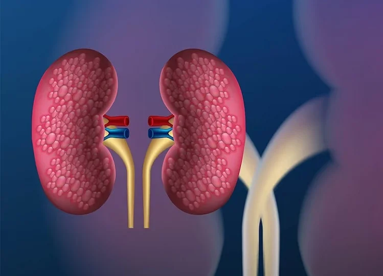 Health Tips: ये हैं किडनी खराब होने के छह प्रमुख लक्षण, नहीं करें नजरअंदाज