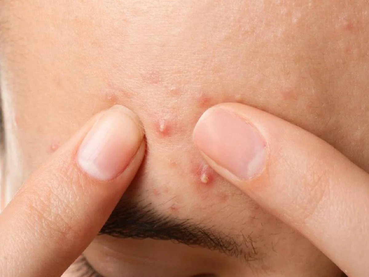 Skincare tips: नाखूनों से पिंपल फोड़ने की नहीं करें गलती, नहीं तो बढ़ जाएगी परेशानी