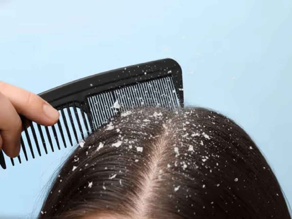Hair Care Tips: बालों में डैंड्रफ की परेशानी को दूर कर देती है दही, इस प्रकार कर लें उपयोग
