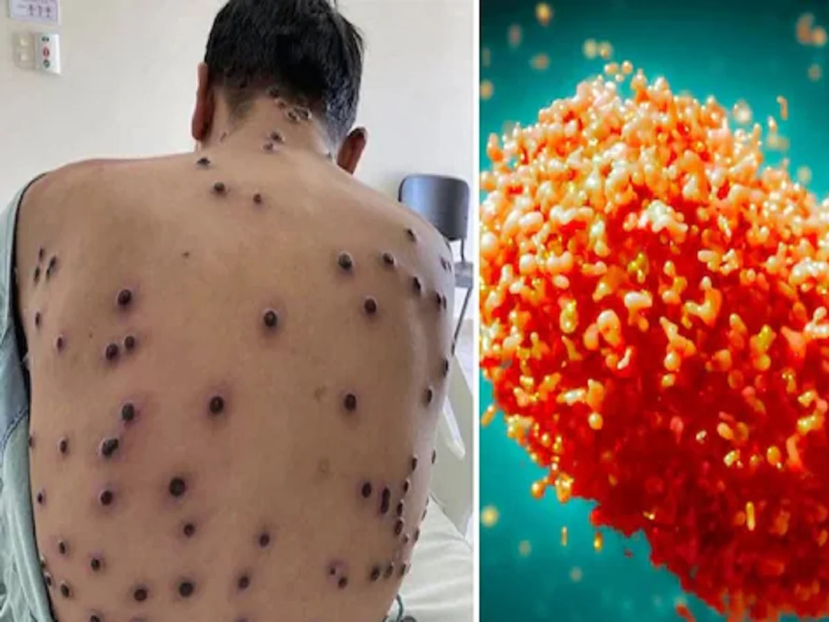 Health Tips: एमपॉक्स वायरस के नए स्ट्रेन ने बढ़ा दी है टेंशन, WHO ने कर दी है पुष्टि, ये हैं लक्षण