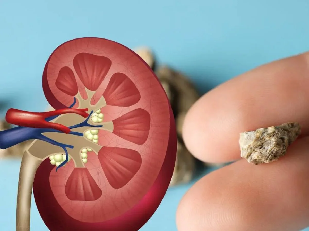 Health Tips: शरीर में पथरी का कारण बनती है ये गलती, गर्मी के मौसम में जरूर करें ऐसा
