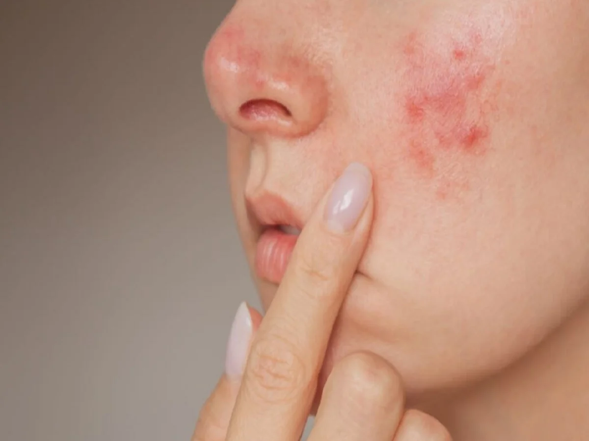 Skin care Tips: बार-बार हो रही है एक्ने की परेशानी, ये हो सकते हैं कारण, जान लें आप