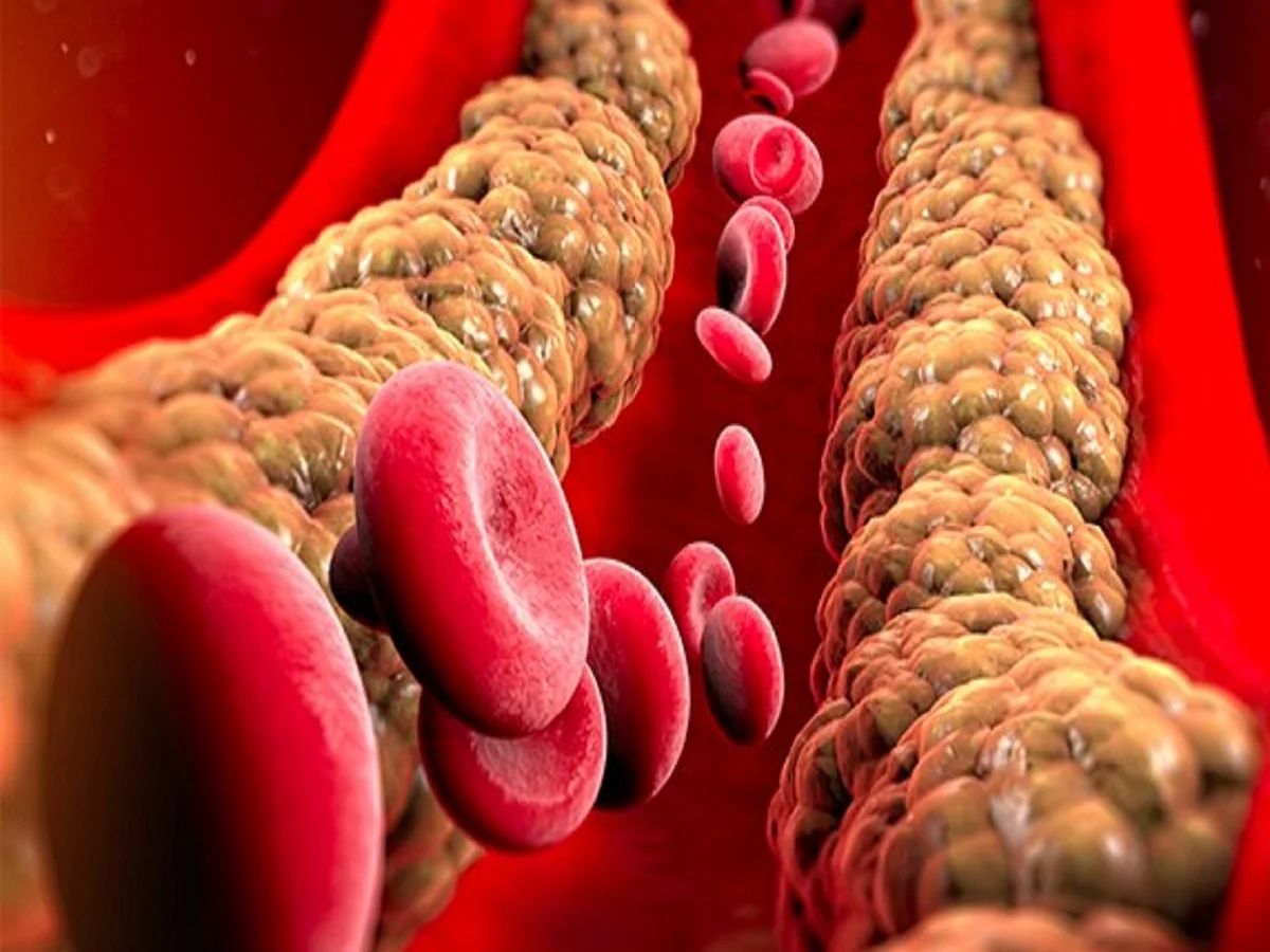 Health Tips: हाई कोलेस्ट्रॉल को कम करने के लिए लाइफस्टाइल में कर लें ये बदलाव