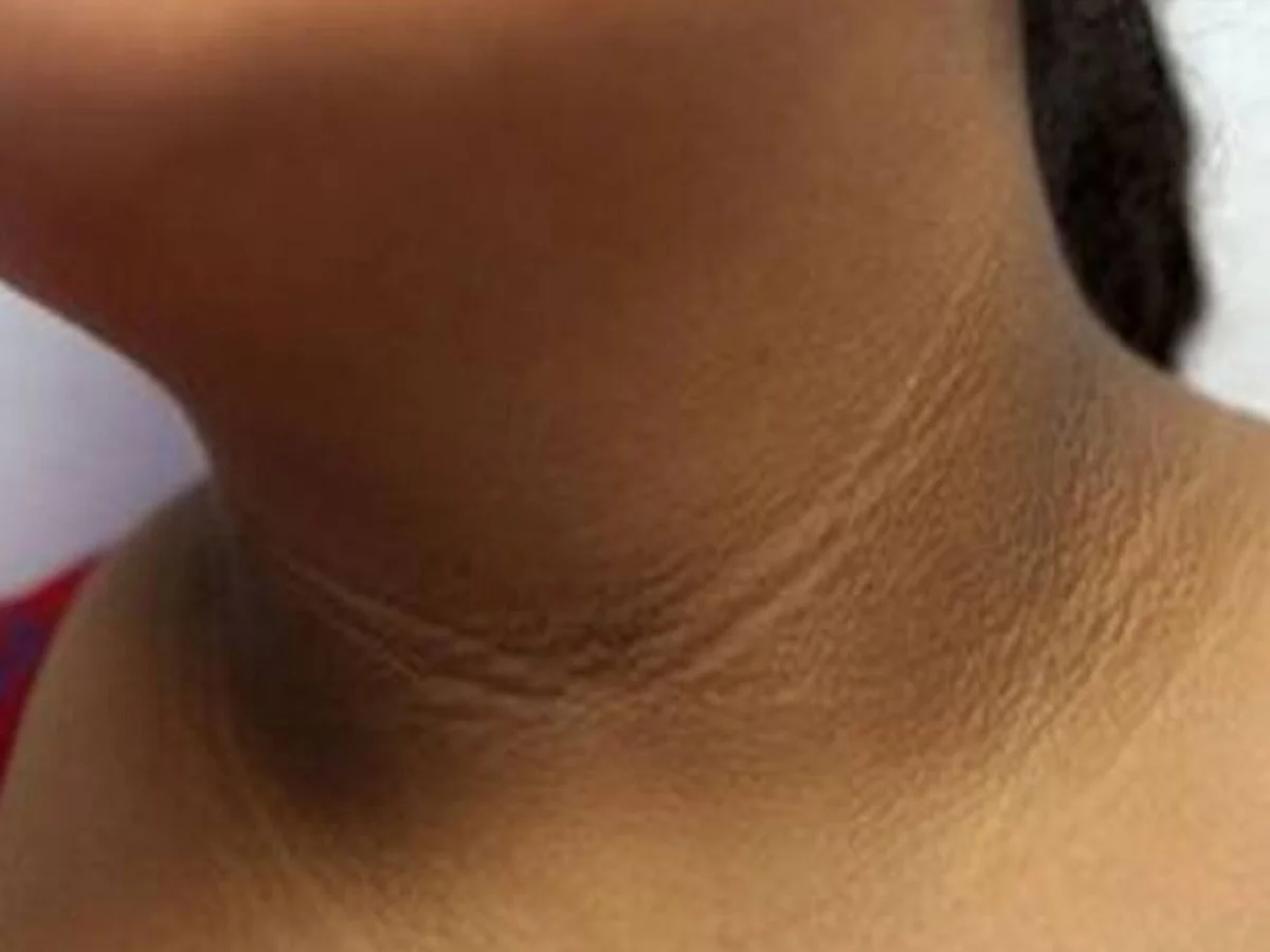 Beauty Tips: संतरे का छिलका कर देगा गर्दन का कालापन दूर, इस प्रकार कर लें उपयोग