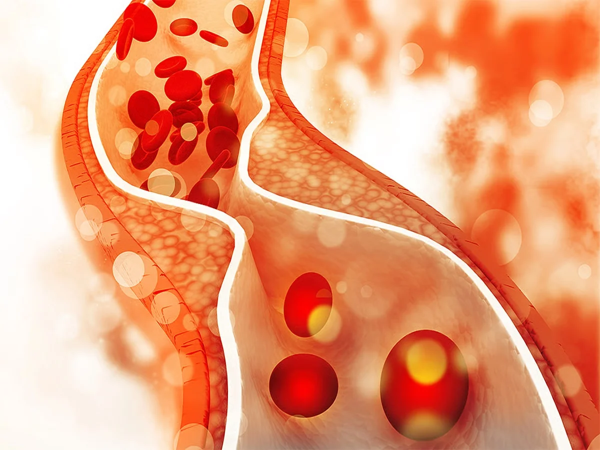 Health Tips:  बढ़ रहा हैं अगर आपका भी कोलेस्ट्रॉल तो त्वचा देती है ये संकेत, पहचाने ऐसे