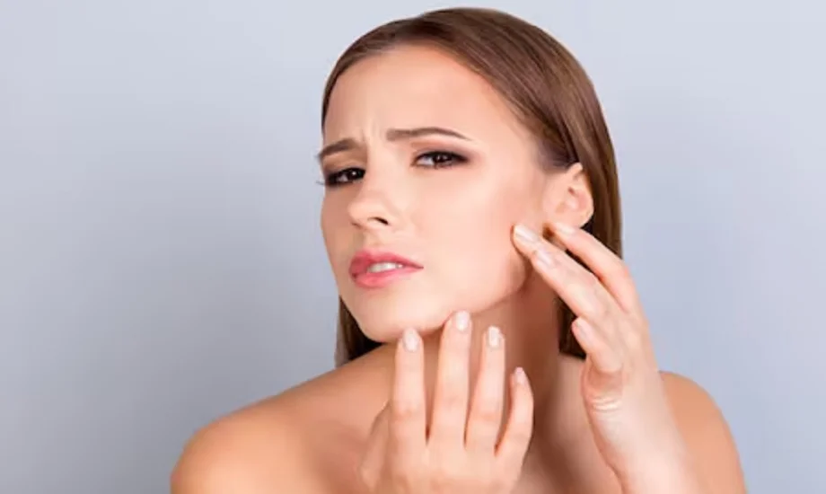 Beauty Tips: मानसून के मौसम में मुंहासों की परेशानी को दूर करने के लिए डाइट में शामिल करें ये चीजें 