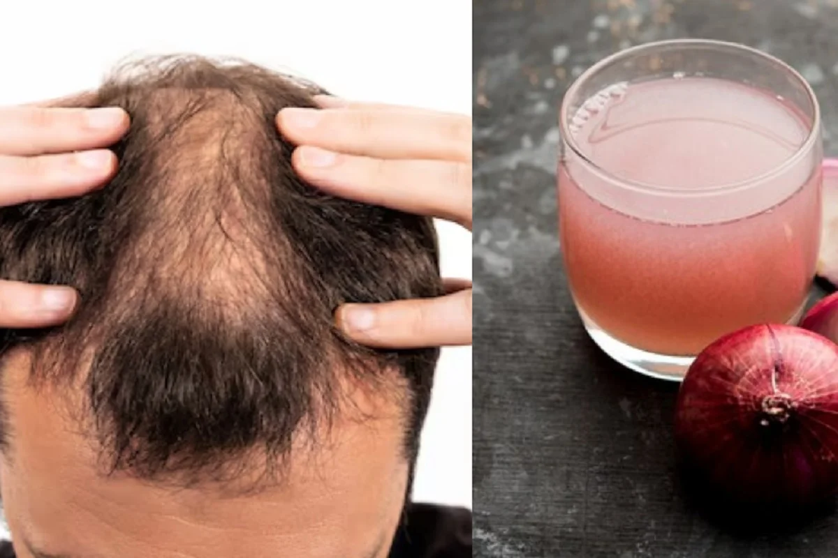 Hair Care Tips: बालों को घने, मजबूत और लंबे बनाने में उपयोगी है प्याज का रस, इस प्रकार करें उपयोग