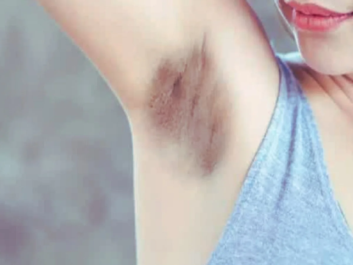 Beauty Tips:  इन चीजों का उपयोग कर काले अंडरआर्म्स को कर लें गोरा