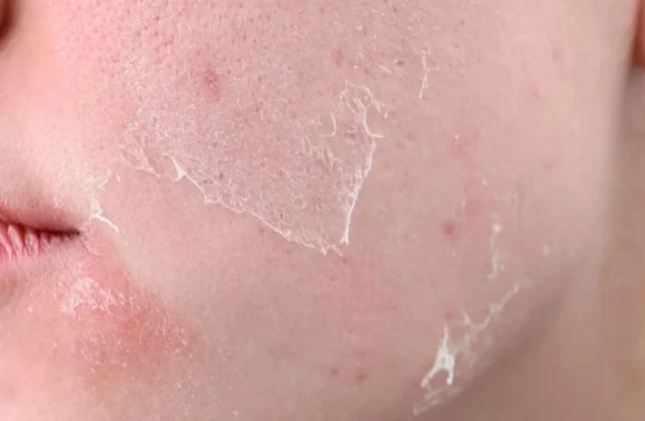 Beauty Tips:  डेड स्किन की परेशानी को दूर कर देगा ये घरेलू फेस पैक