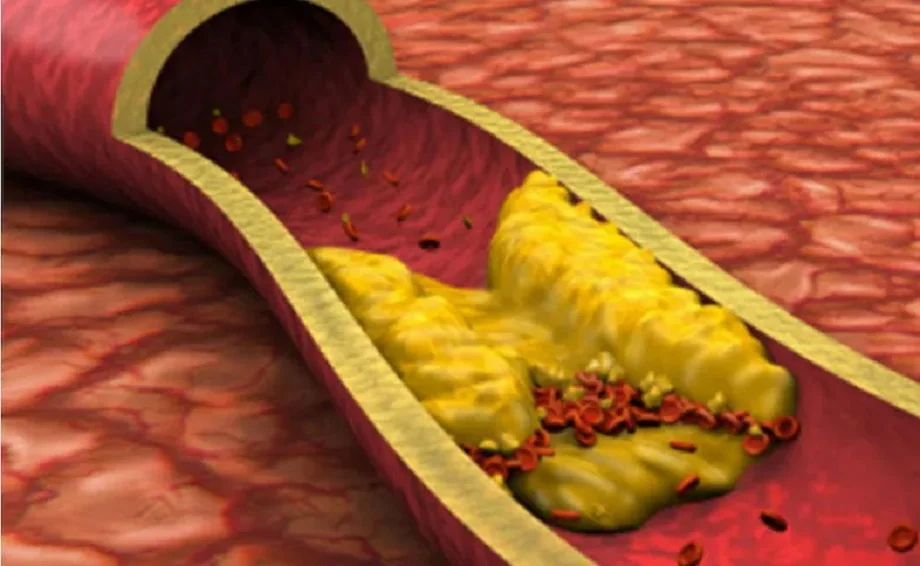 Health Tips: हाई कोलेस्ट्रॉल को कम करने के लिए आज ही से कर लें जीवनशैली में ये बदलाव, मिलेगा फायदा