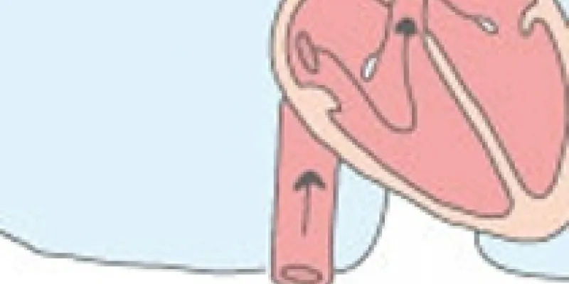 51 Lungeembol 1 75nm8tfdq