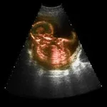 Barnlose fertilitetsbehandling