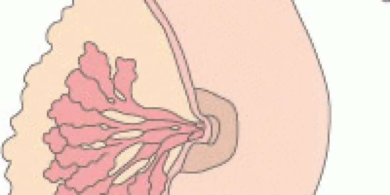 Brystcancer 75nm8tfi7