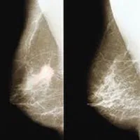 Brystcancer overvaegt