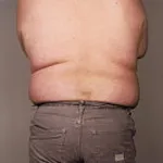 Fedmeepidimi er bremset