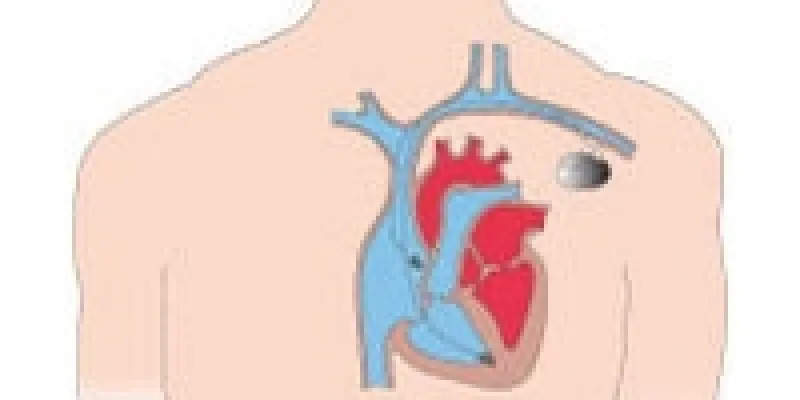 Hjertekarsygdomme pacemaker 75nm8tfle