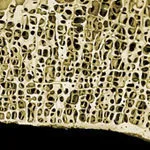 Knogleskorhed osteosperose haandled