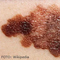 Melanon modermaerkecancer