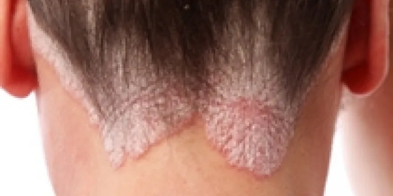 Psoriasis harbund 75nm8tgd3