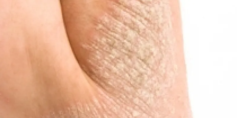 Psoriasis plaque 75nkwkbhg