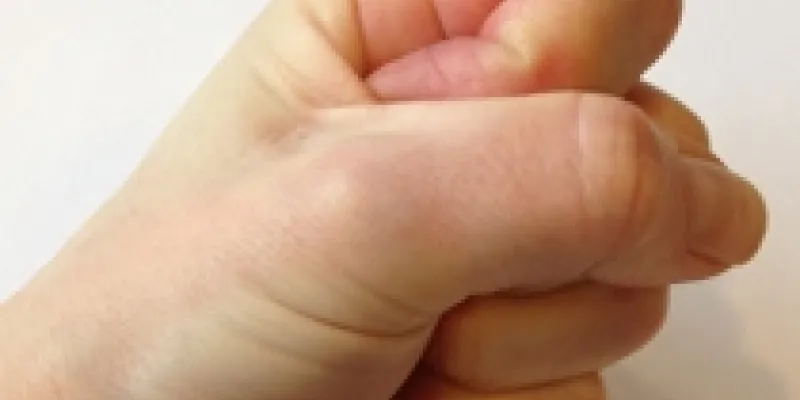 Psoriasis psoriasisgigt1 75nm8tf2a