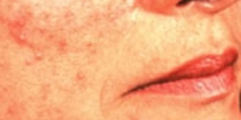 Rosacea 75nm8t8pp