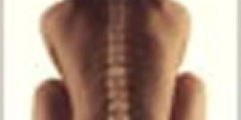 Rygproblemer scheuermanns sygdom 75nm8tevi