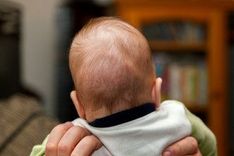 Voorkeurshouding, torticollis en vormafwijkingen van het babyhoofd