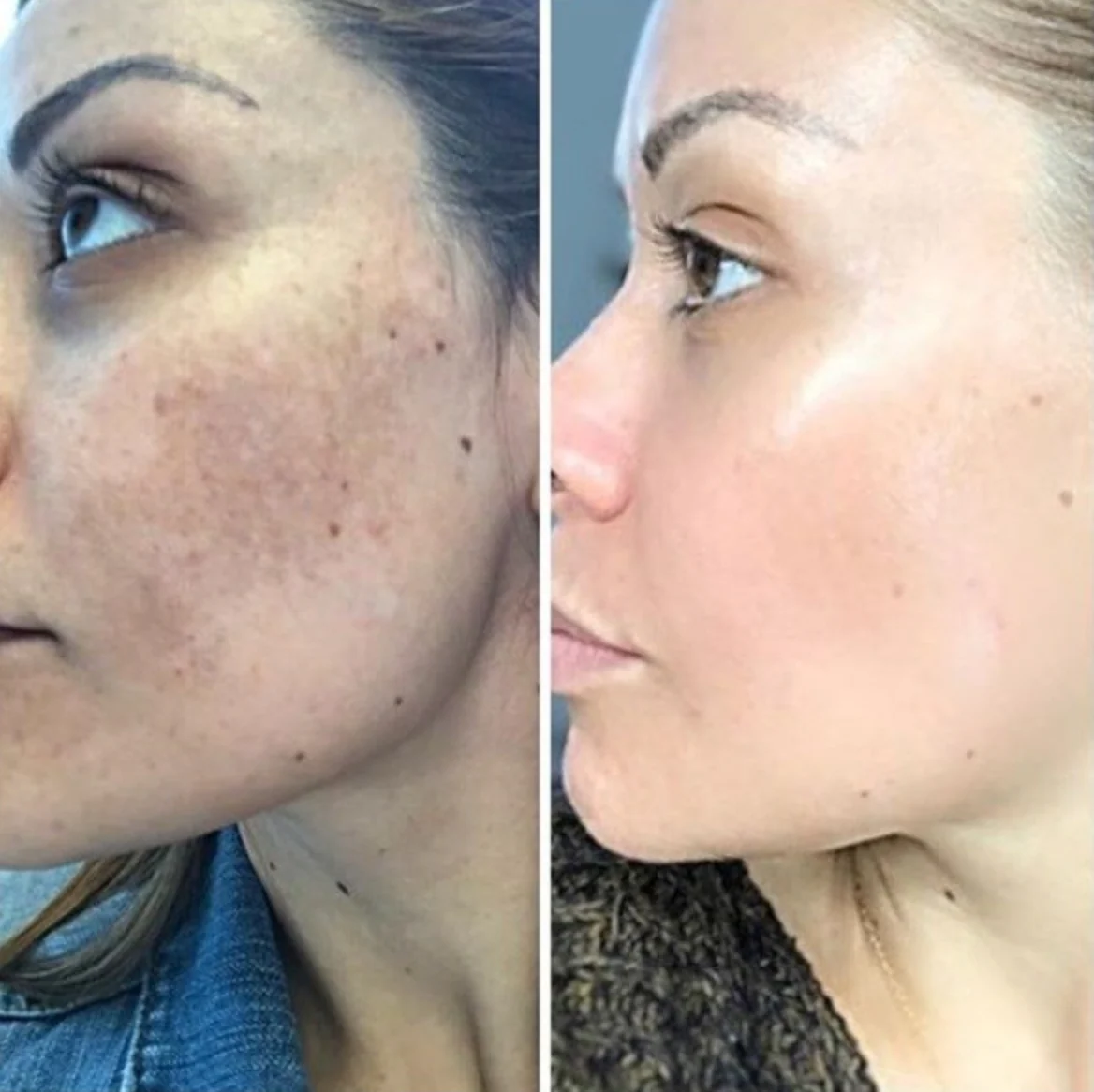 🌸DEEP MELASMA CONSULTATION - PERSONALIZED REGIMEN FOR BRIGHT, HEALTHY SKIN🌸