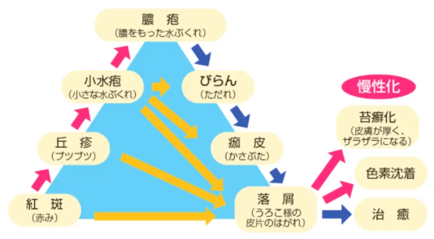 湿疹 アトピー性皮膚炎 おむつ皮膚炎 脂漏性皮膚炎