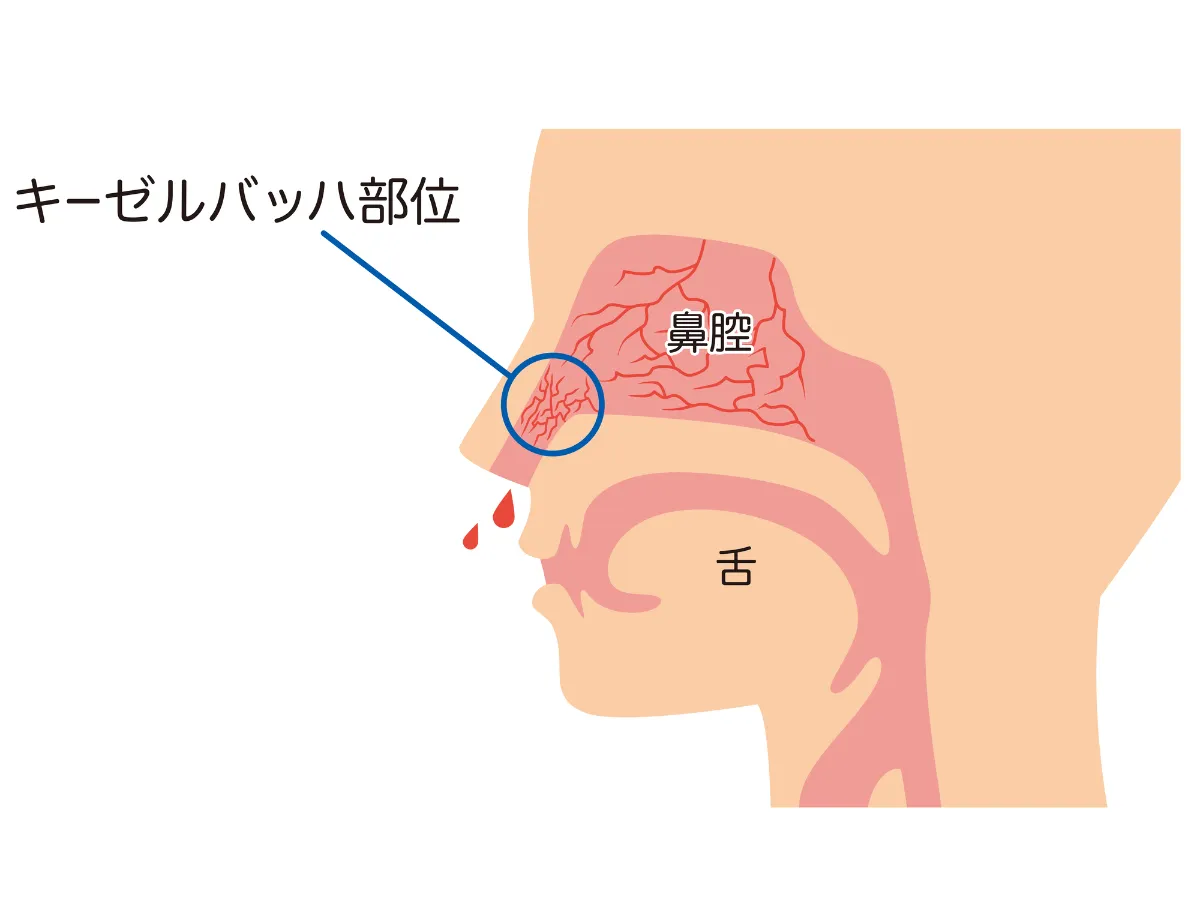 鼻 を かむ と 血 が 出る
