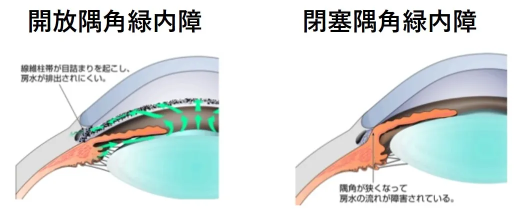 All About 開放隅角緑内障 LI(レーザー虹彩切開術)】狭隅角・閉塞隅角緑内障の治療法とは
