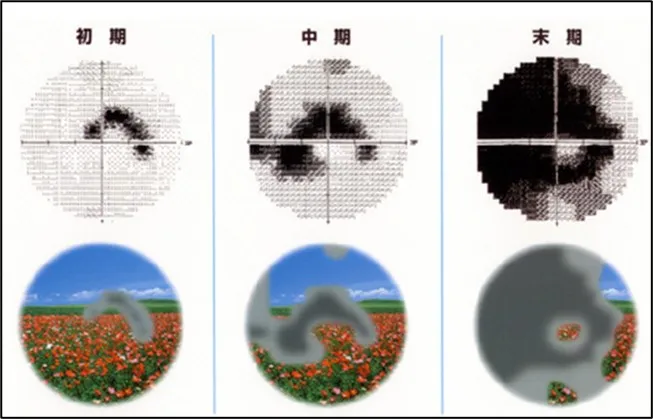 All About 開放隅角緑内障（裁断済み） Amazon.co.jp: All About 原発閉塞隅角緑内障 (眼科臨床