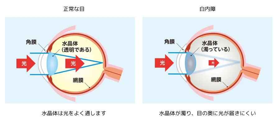 スタンダード白内障手術 メジカルビュー社｜眼科｜スタンダード白内障手術［Web動画付］