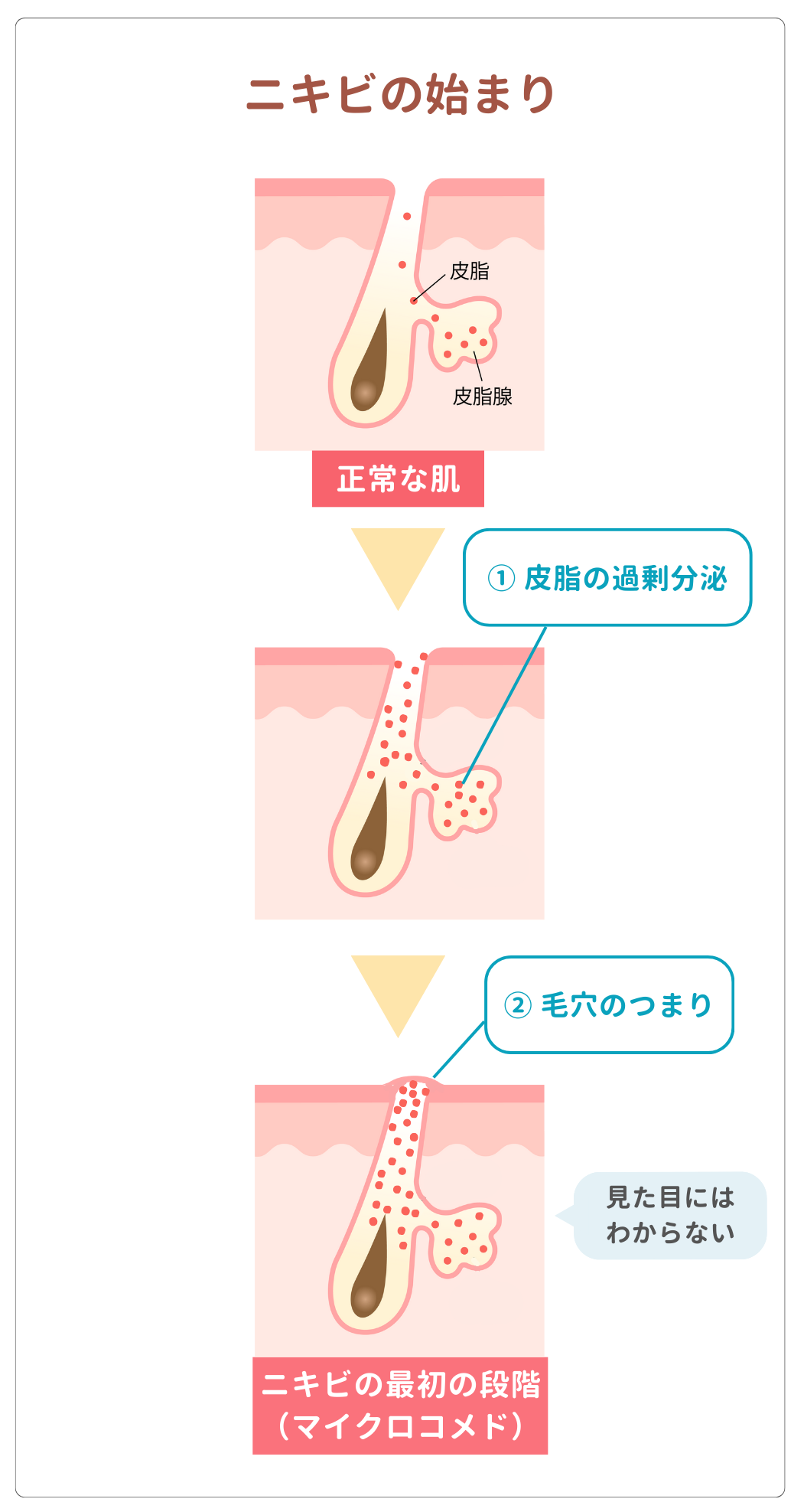 （おでき） ニキビ（尋常性痤瘡）｜どんな病気？