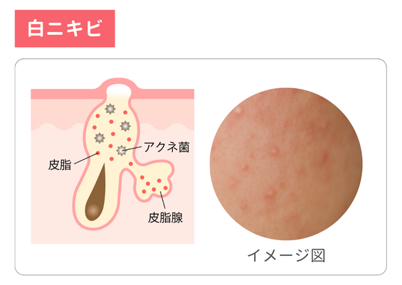 白ニキビの図。毛穴に皮脂とアクネ菌がたまり、表面が白く盛り上がった状態を示している。右側には白ニキビの写真イメージがある。