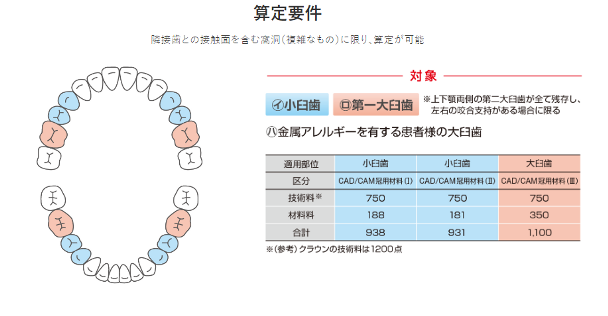 CAD/CAM冠の適用部位について