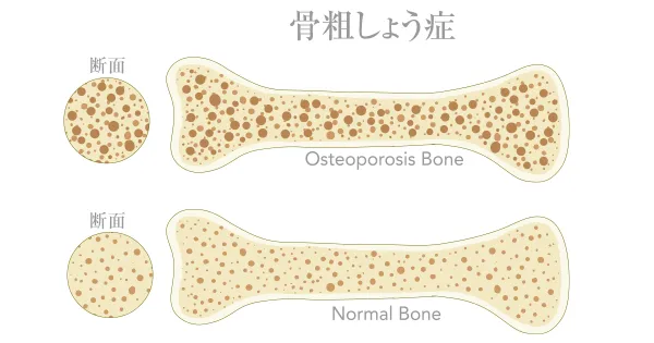 骨粗しょう症とBFRトレーニングの可能性