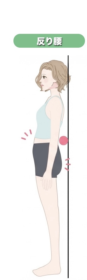 反り腰