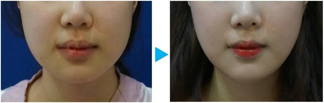 脂肪溶解注射|東京銀座の美容皮膚科|トラスト美容クリニック 脂肪溶解注射|東京銀座の美容皮膚科|トラスト美容クリニック
