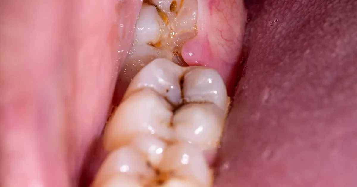 智齿拔除的潜在风险
