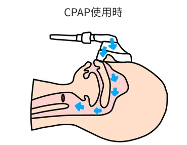 CPAP装置を装着した横顔の断面図。鼻から空気が送られ、気道を広げる様子を示す矢印が描かれている。
