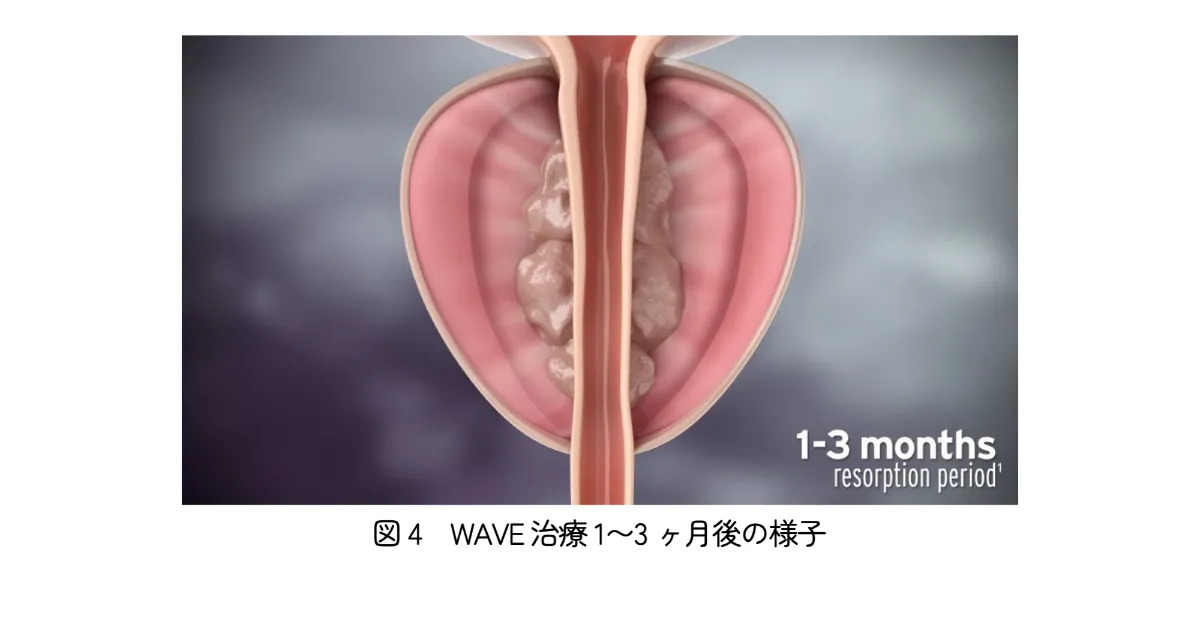 前立腺の手術 身体にやさしい前立腺治療 ｜ 伯鳳会グループ
