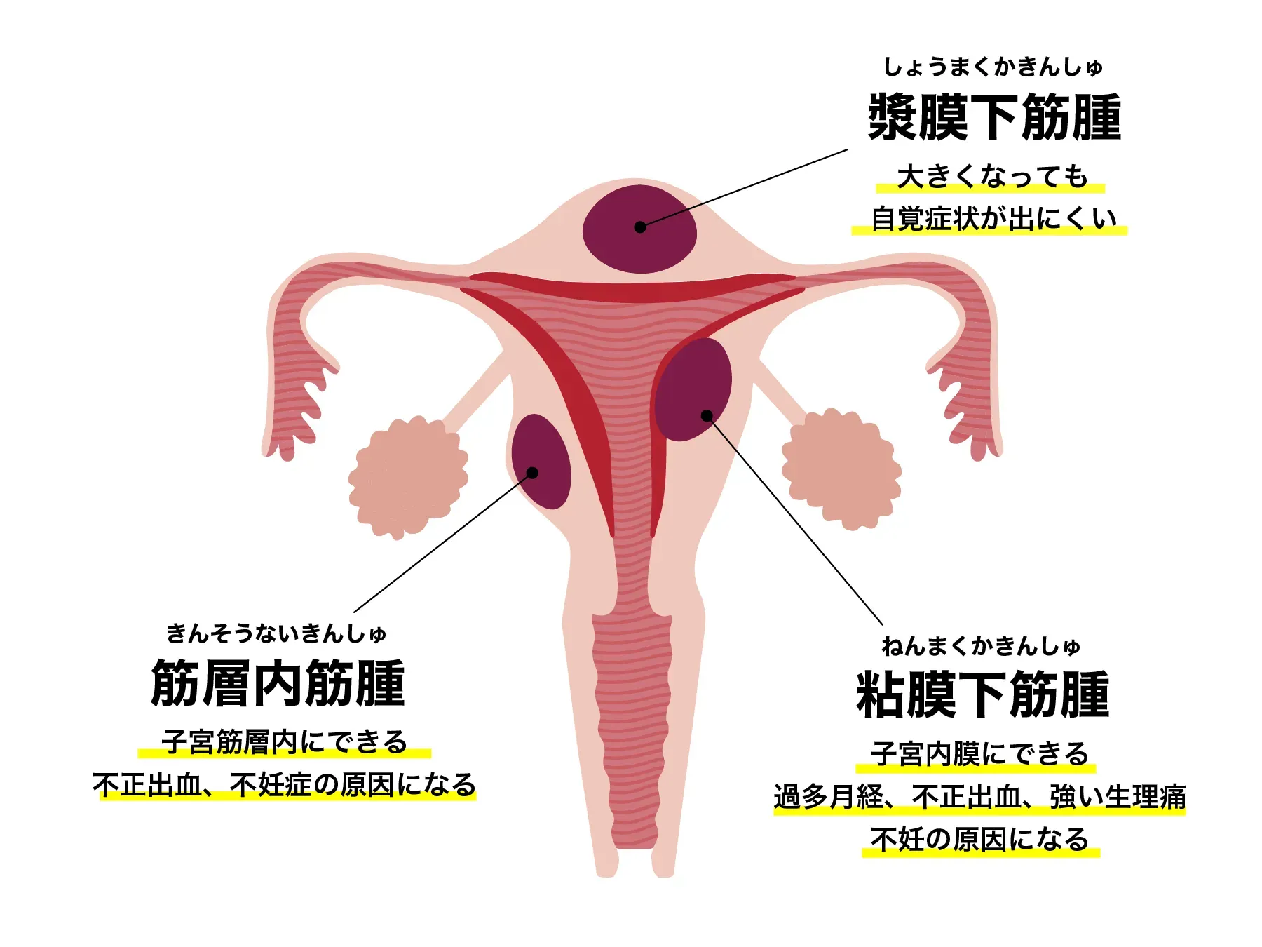子宮筋腫の臨床 109I58 | 子宮筋腫, 子宮腺筋症 国試 | テコプラ