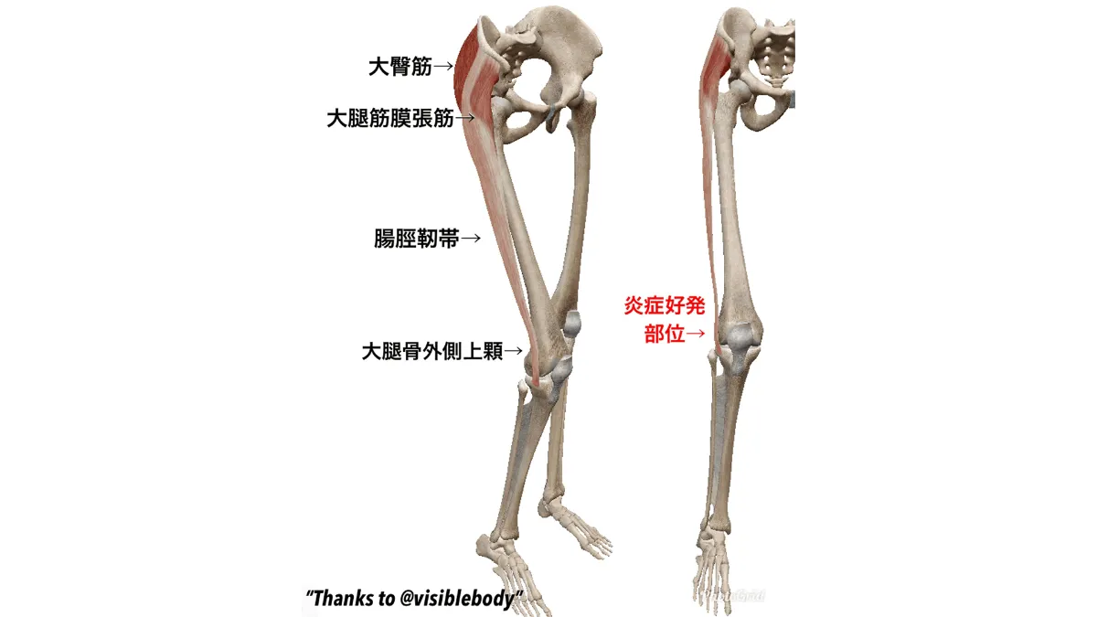 ランナー必見 腸脛靭帯炎から解放される原因別 腸脛靭帯炎解消 マニュアル Orphe Journal ランナー必見 腸脛靭帯炎から解放される原因別 腸脛靭帯炎解消 マニュアル Orphe Journal