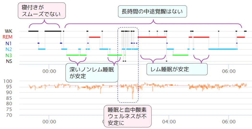 睡眠グラフを読む 〜脳波計測なら睡眠の質がここまで分かる！ ～ ｜S