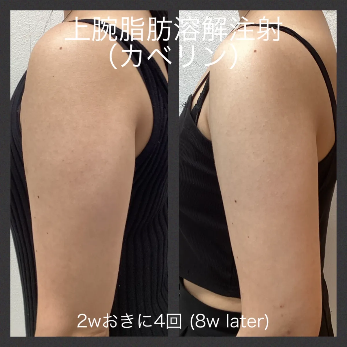 脂肪溶解注射（カベリン）を用いた症例 - JR渋谷駅から徒歩1分 アヤナ