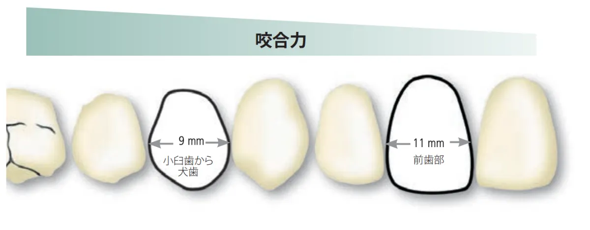 二ケイ酸リチウム系セラミックス 〜e-maxの基本〜 |エミウム 二ケイ酸リチウム系セラミックス 〜e-maxの基本〜 |エミウム